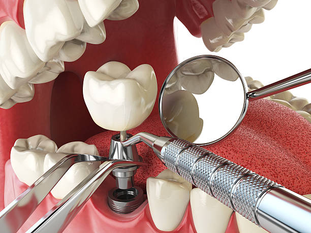 Best Emergency Wisdom Teeth Removal in Fairwood, WA